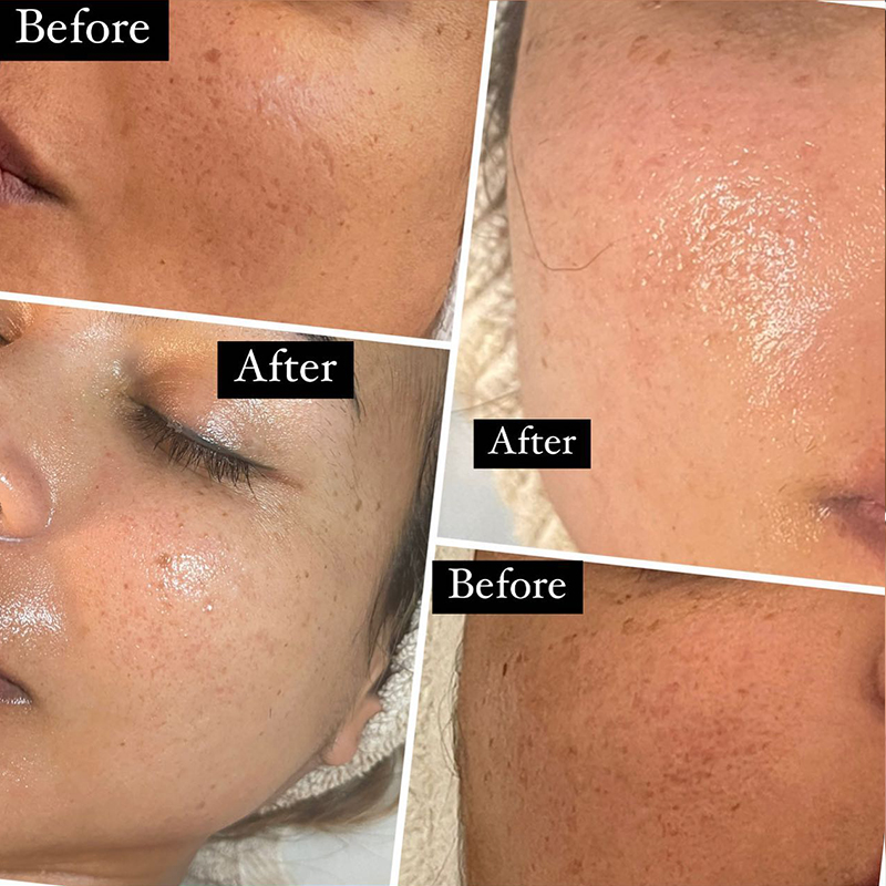 micro needling