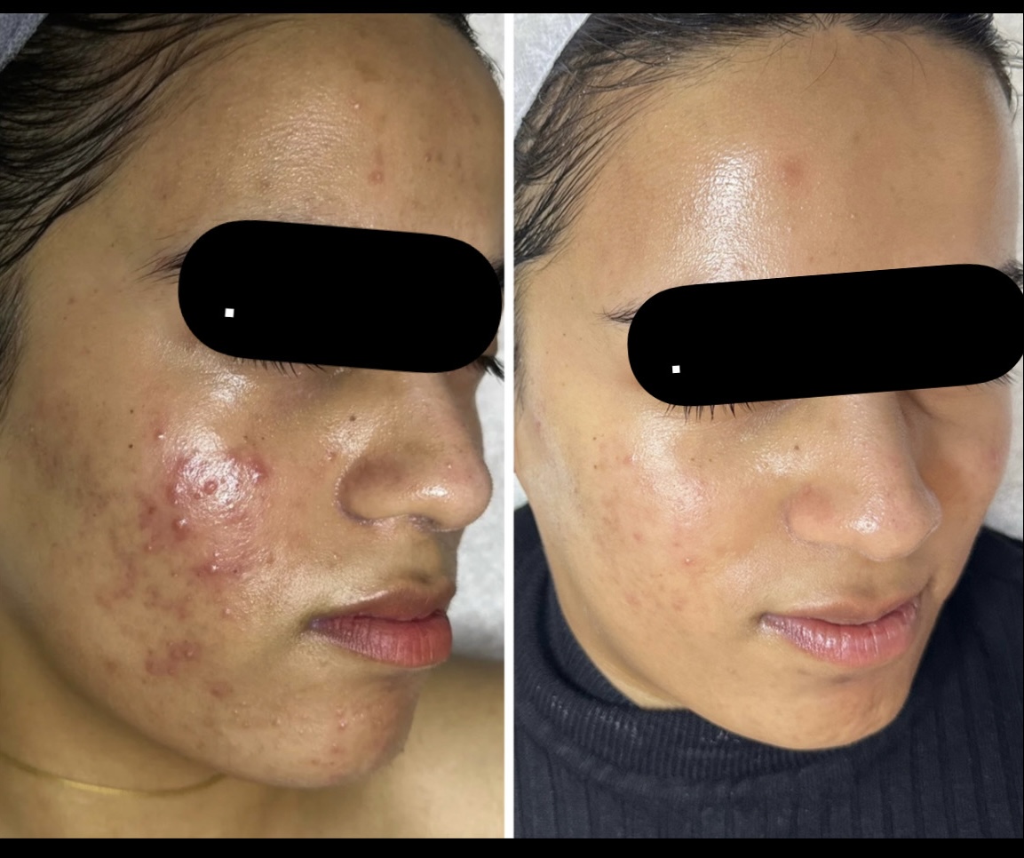Micro needling