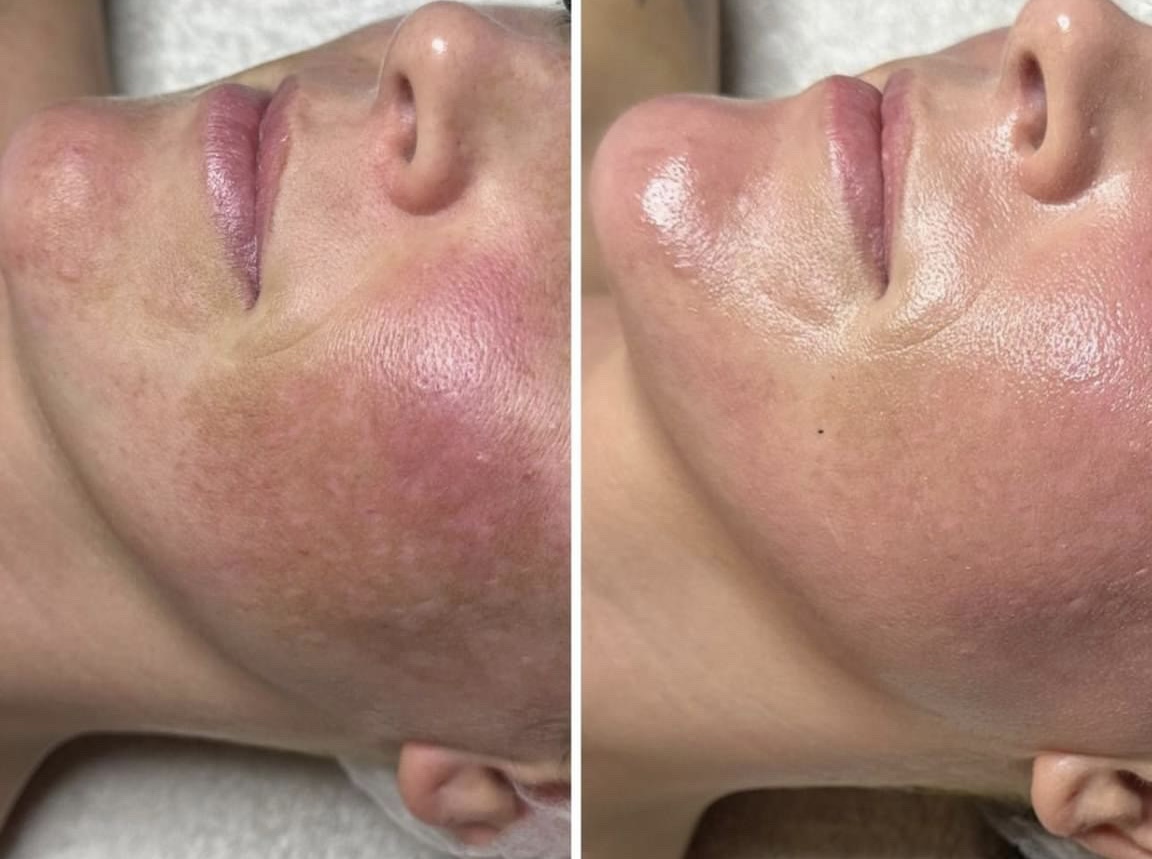 BB GLOW TREATMENT 