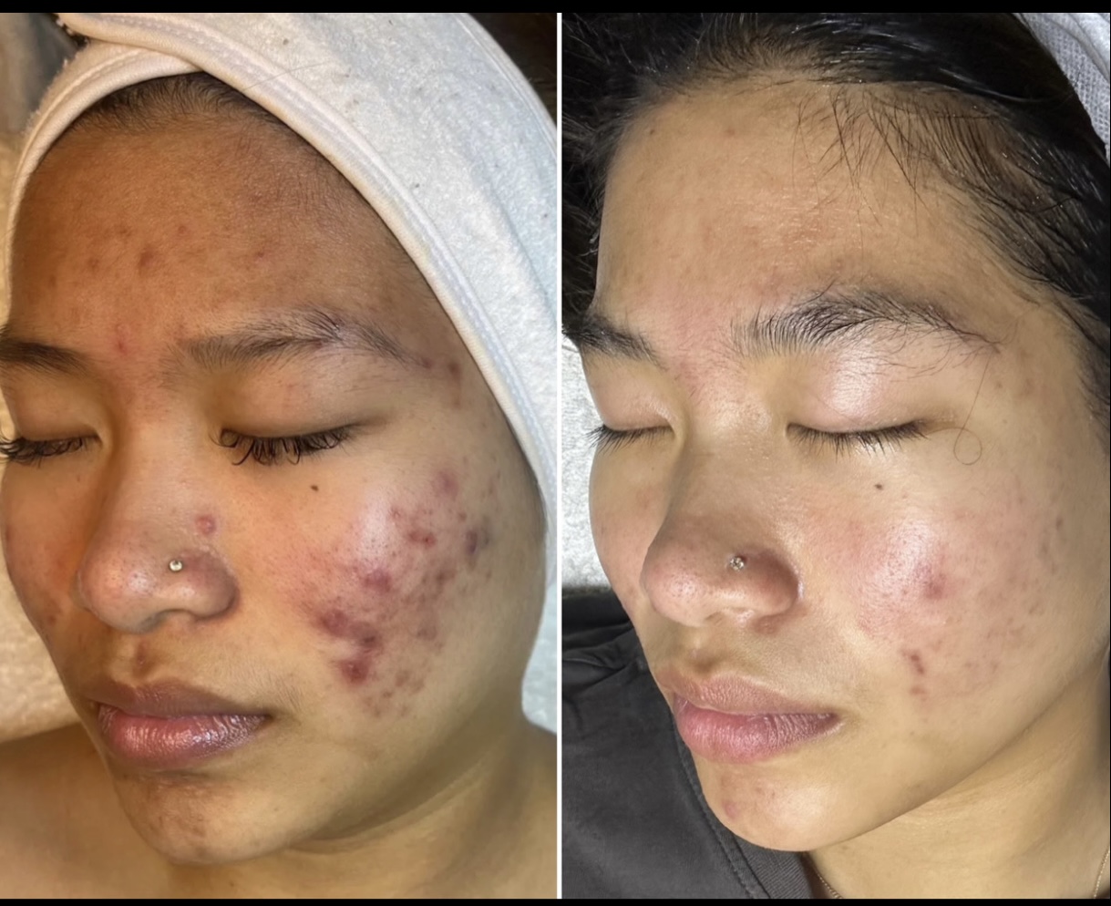 Micro needling
