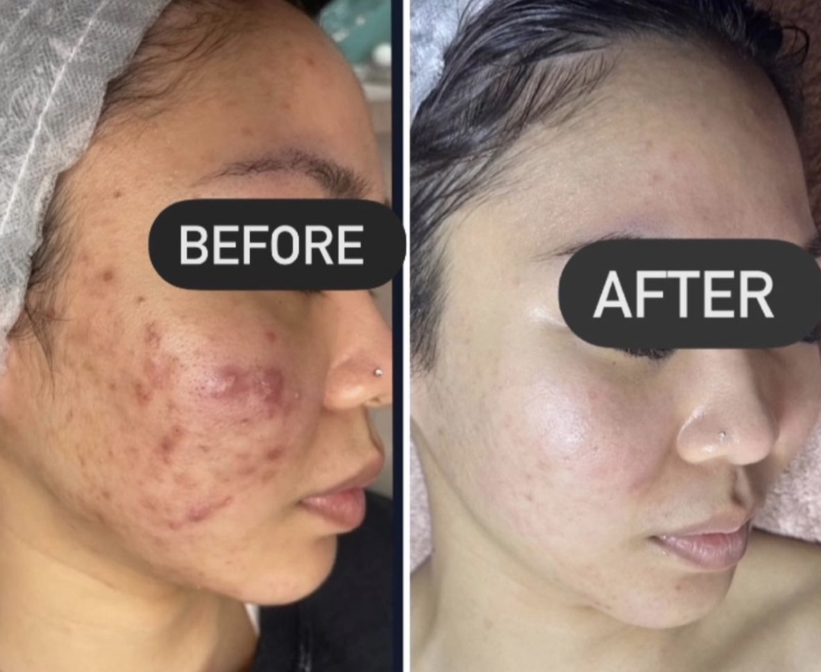 Micro needling